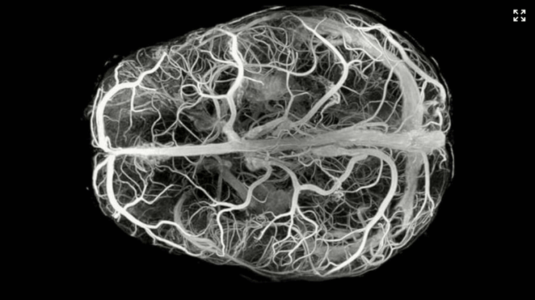 Screenshot 2025-11-05 at 09-58-01 Descubren enfermedad ultrarrara con solo 13 casos en el mundo - Diario Libre