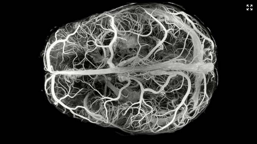 Screenshot 2025-11-05 at 09-58-01 Descubren enfermedad ultrarrara con solo 13 casos en el mundo - Diario Libre